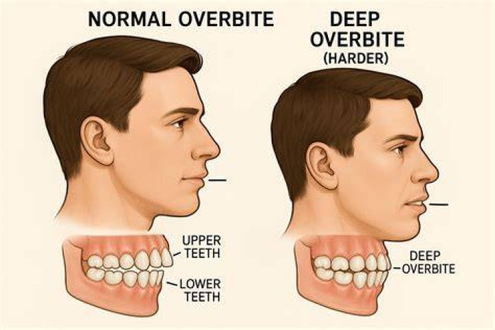 Are You Supposed To Have An Overbite