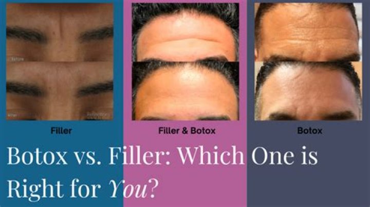 Botox and fillers - How To Discuss