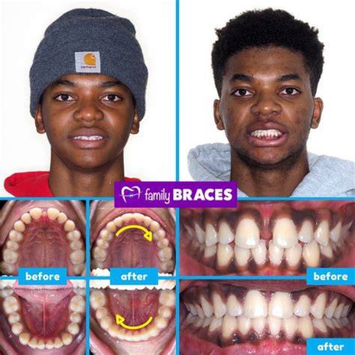 Braces Giving Me A Gap