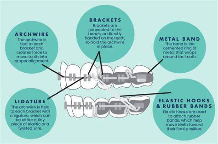 Brackets - How To Discuss