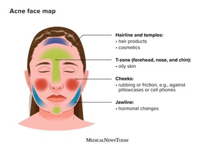 Breaking out on neck - How To Discuss