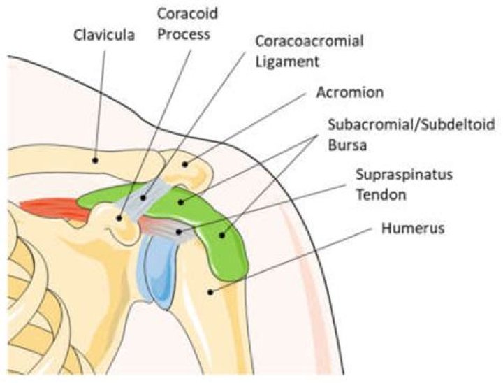 Bursite Subacromial SubdeltÃ³idea - How To Discuss