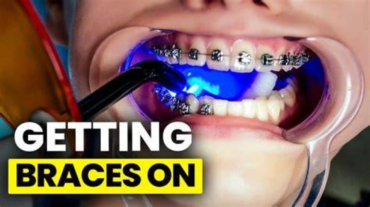 Can You Get Braces Put On The Same Day