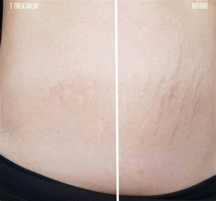 Can you get rid of stretch marks