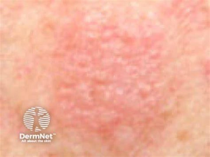 Carba Mix Allergy Symptoms - How To Discuss