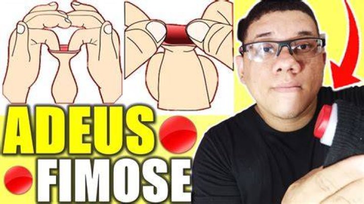 Como Perder A Fimose - How To Discuss