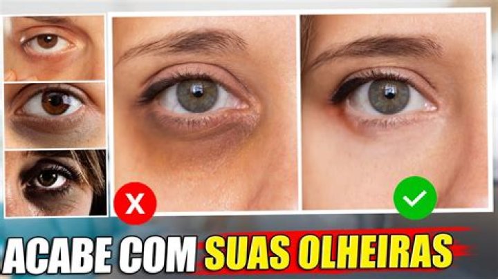 Como Remover Olheiras - How To Discuss