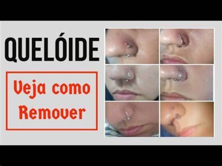 Como Tirar Queloide Do Nariz