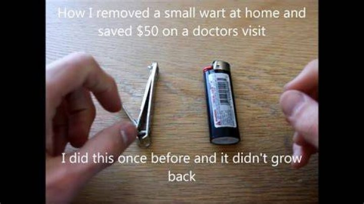 Cut Wart Off With Nail Clippers
