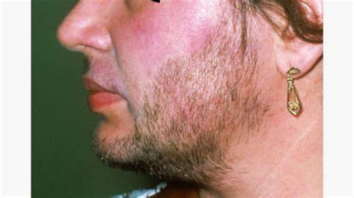 Hair growth on face due to hormonal imbalance