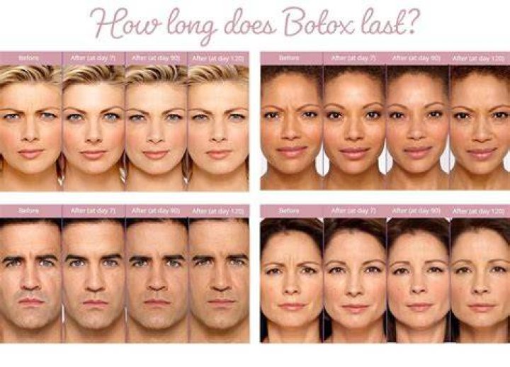 How long does botox last