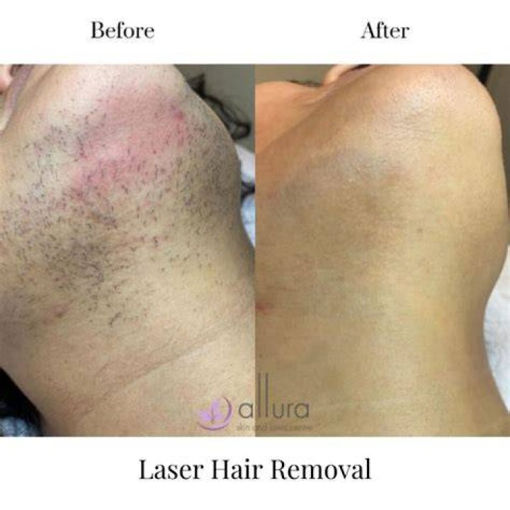 How long does laser hair removal last