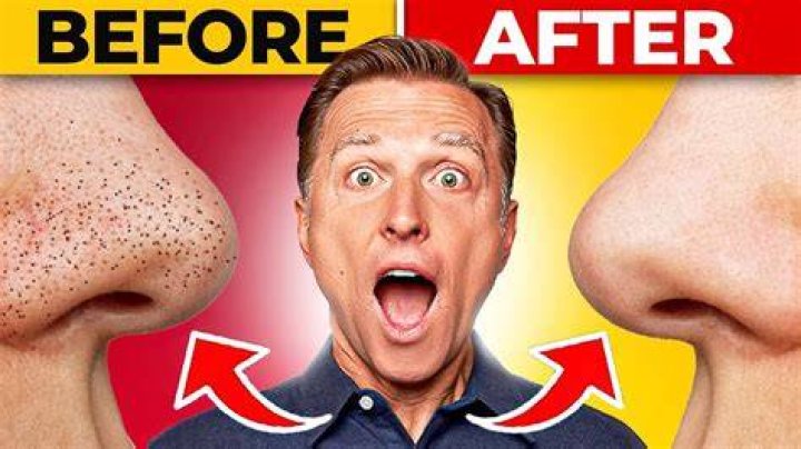 How to clear blackheads - How To Discuss