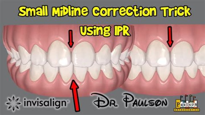 Ipr Invisalign - How To Discuss
