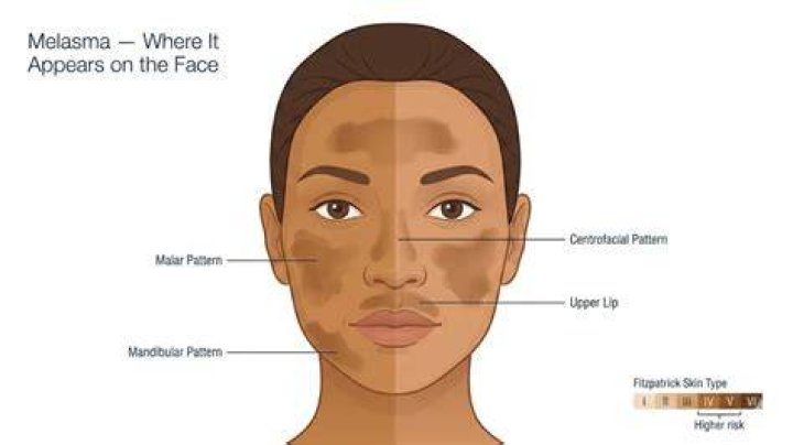 Melasma on face - How To Discuss