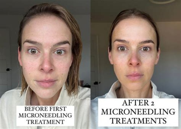 Microneedling reviews - How To Discuss