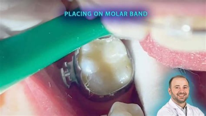 Molar band - How To Discuss