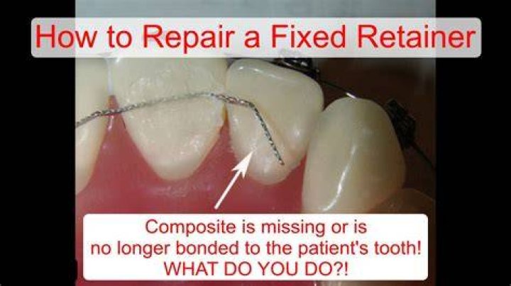My Retainer Is Cracked - How To Discuss