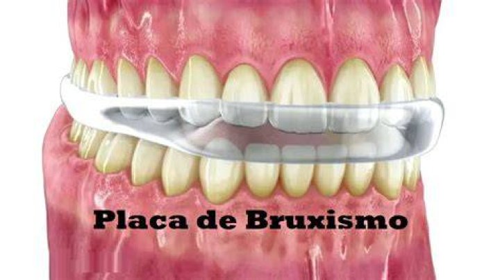 Placa De Bruxismo Valor - How To Discuss