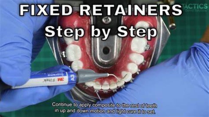 Retainer - How To Discuss