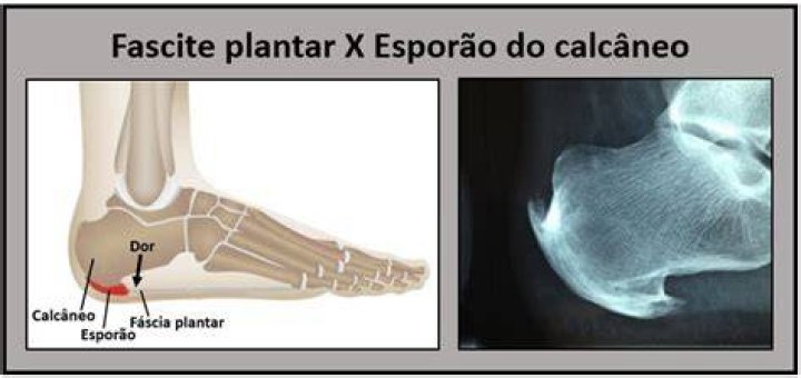 Simpatia Para EsporÃ£o De Calcaneo