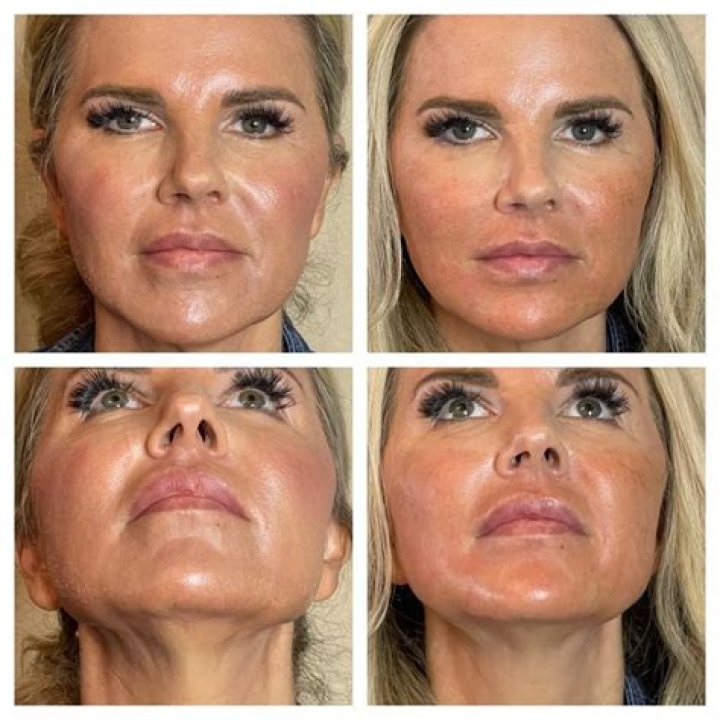String face lifts - How To Discuss