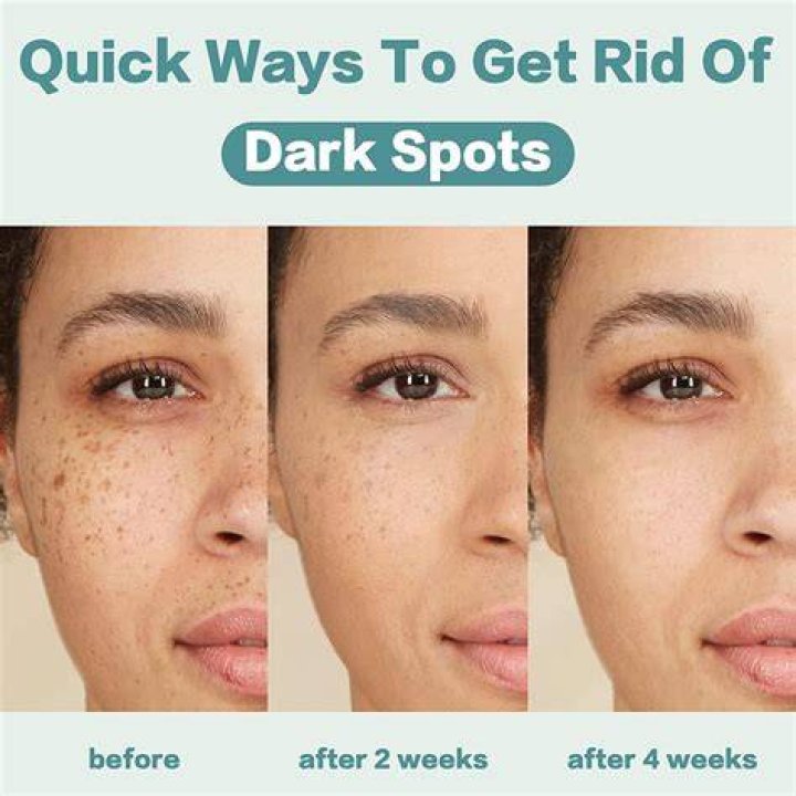Treatment for dark spots on face