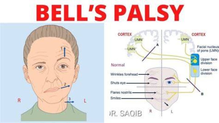 What is Bells Palsy? - How To Discuss